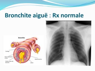 Bronchite aiguë : Rx normale
 