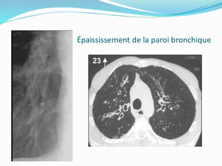 Épaississement de la paroi bronchique
 