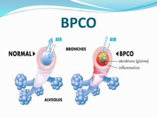 BPCO
 