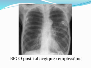 BPCO post-tabacgique : emphysème
 