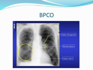BPCO
 
