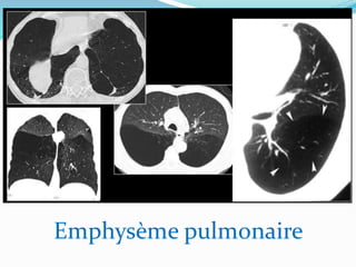 Emphysème pulmonaire
 