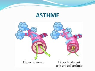 ASTHME
 