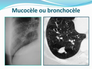 Mucocèle ou bronchocèle
 