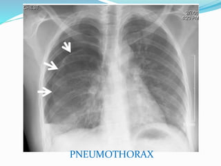 PNEUMOTHORAX
 