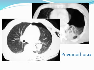 Pneumothorax
 