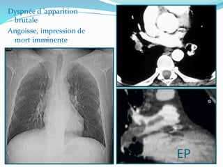 Dyspnée d ’apparition
brutale
Angoisse, impression de
mort imminente
EP
 