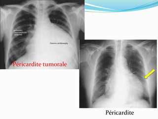 Péricardite tumorale
Péricardite
 