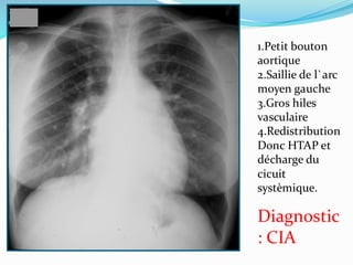 1.Petit bouton
aortique
2.Saillie de l`arc
moyen gauche
3.Gros hiles
vasculaire
4.Redistribution
Donc HTAP et
décharge du
cicuit
systèmique.
Diagnostic
: CIA
 