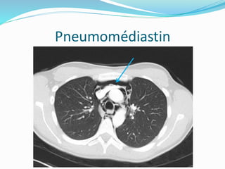 Pneumomédiastin
 