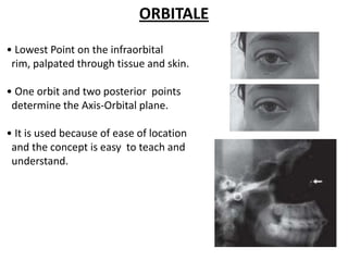 ORBITALE
• Lowest Point on the infraorbital
rim, palpated through tissue and skin.
• One orbit and two posterior points
determine the Axis-Orbital plane.
• It is used because of ease of location
and the concept is easy to teach and
understand.
 