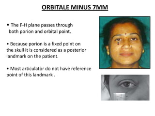 ORBITALE MINUS 7MM
• The F-H plane passes through
both porion and orbital point.
• Because porion is a fixed point on
the skull it is considered as a posterior
landmark on the patient.
• Most articulator do not have reference
point of this landmark .
 
