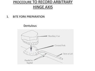 PROCEDURE TO RECORD ARBITRARY
HINGE AXIS
1. BITE FORK PREPARATION
Dentulous
 