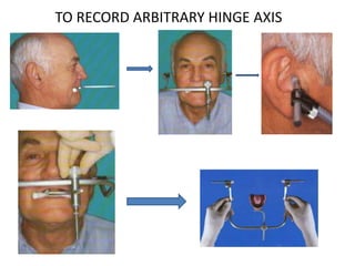TO RECORD ARBITRARY HINGE AXIS
 