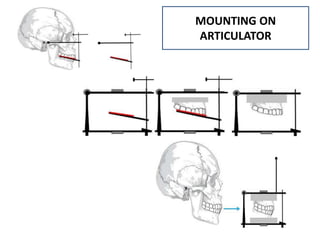 MOUNTING ON
ARTICULATOR
 
