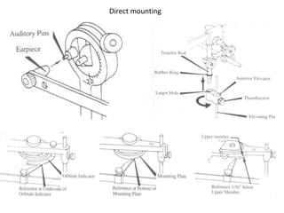 Direct mounting
 