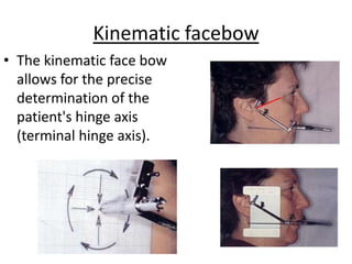 Kinematic facebow
• The kinematic face bow
allows for the precise
determination of the
patient's hinge axis
(terminal hinge axis).
 