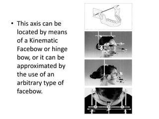• This axis can be
located by means
of a Kinematic
Facebow or hinge
bow, or it can be
approximated by
the use of an
arbitrary type of
facebow.
 