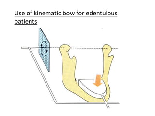 uuuu
Use of kinematic bow for edentulous
patients
 