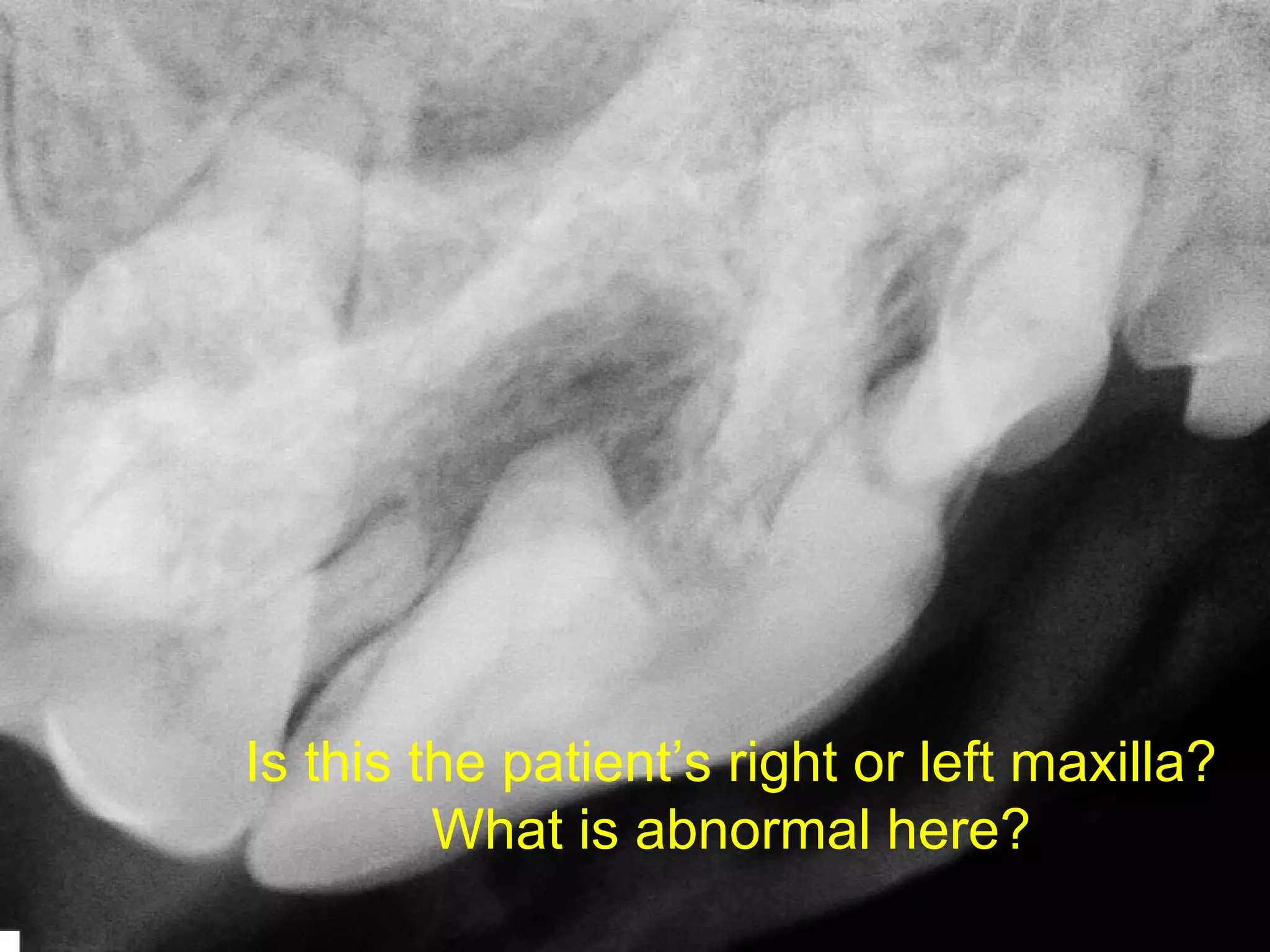 Is this the patient’s right or left maxilla?
         What is abnormal here?
 