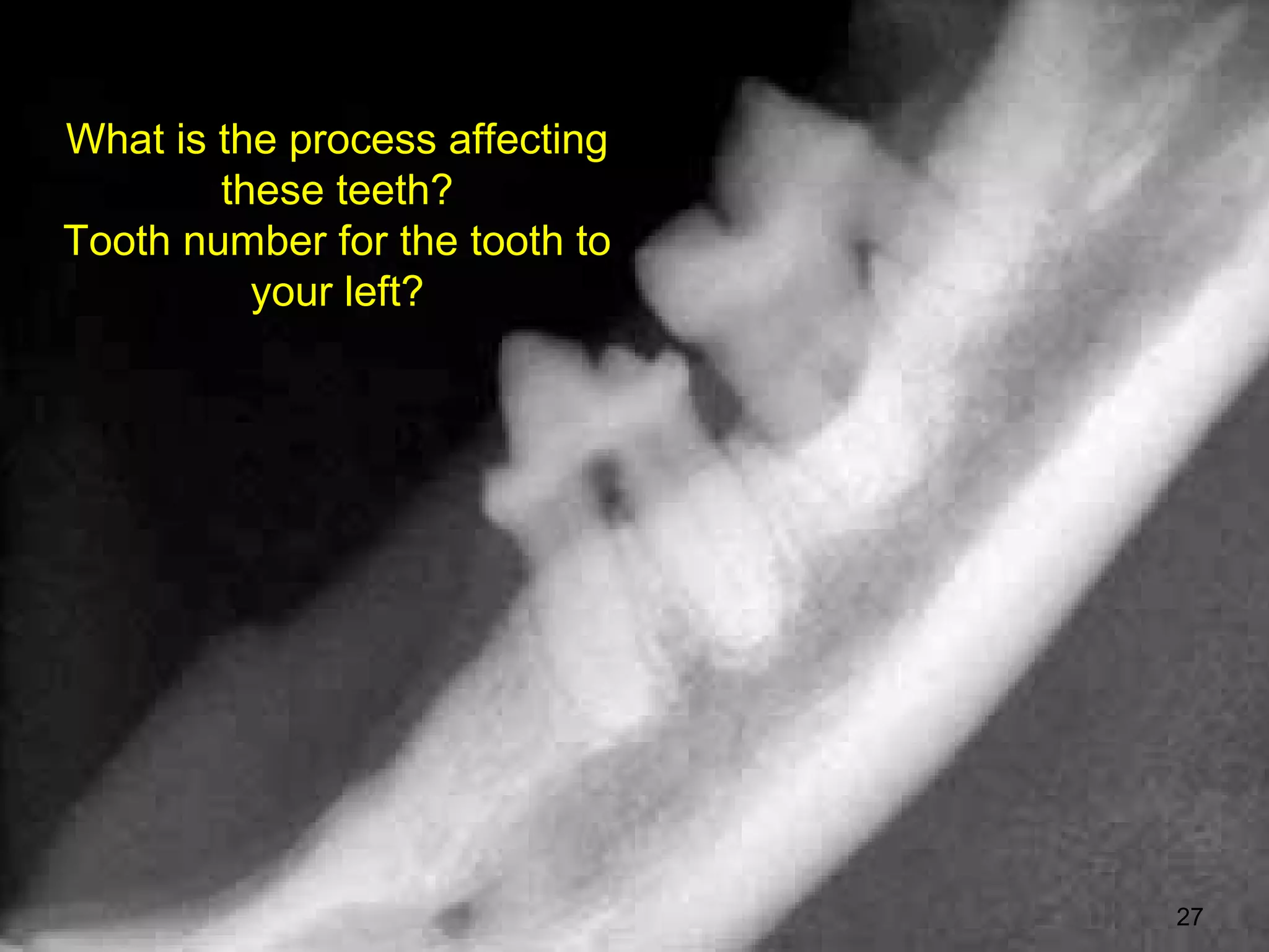 What is the process affecting
        these teeth?
Tooth number for the tooth to
          your left?




                                27
 