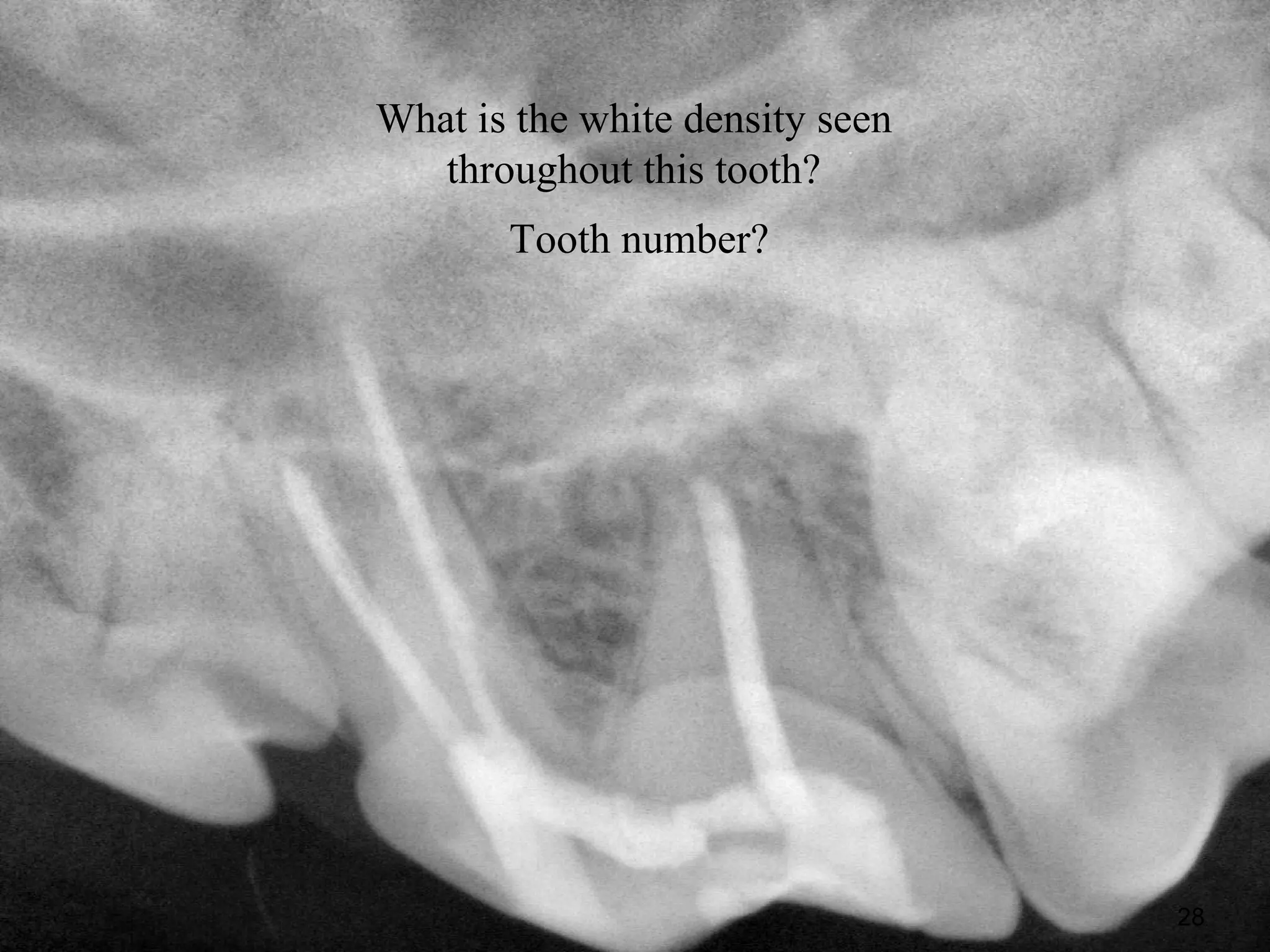 What is the white density seen
   throughout this tooth?
       Tooth number?




                                 28
 