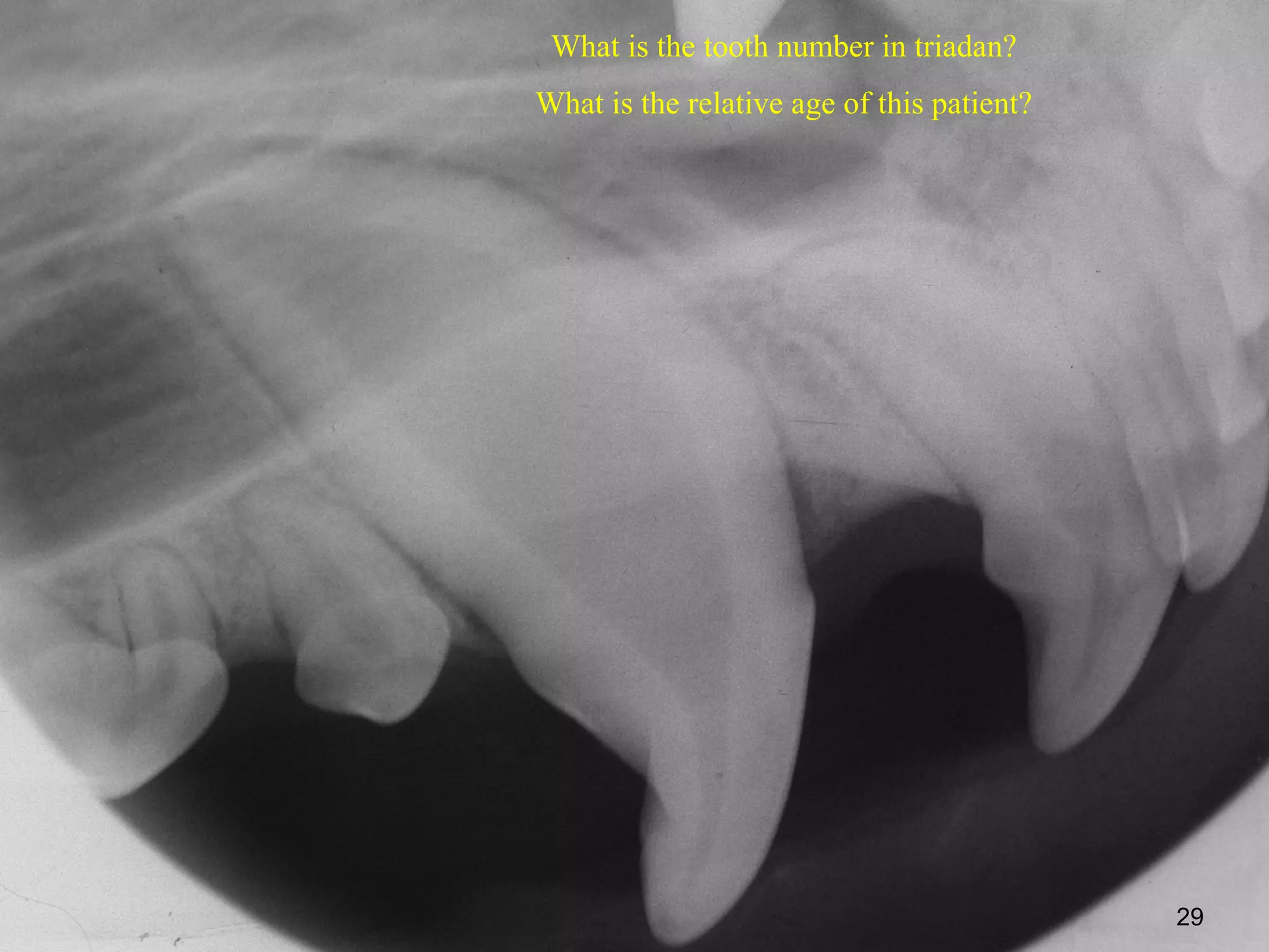 What is the tooth number in triadan?
What is the relative age of this patient?




                                            29
 