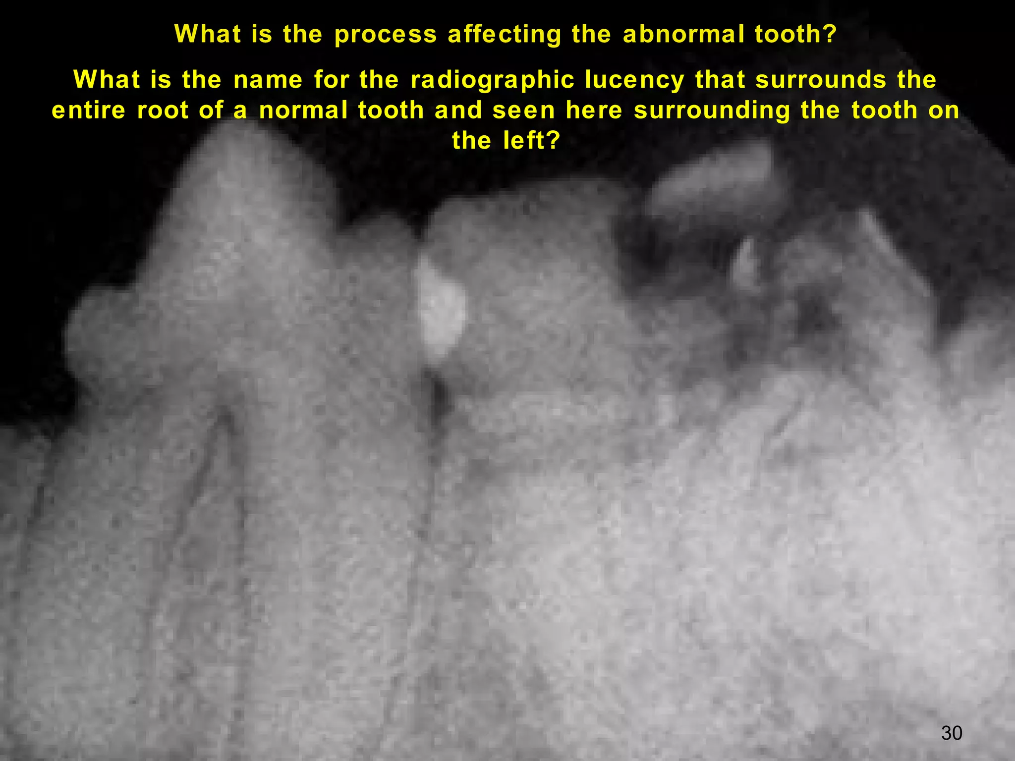 What is the process affecting the abnormal tooth?
 What is the name for the radiographic lucency that surrounds the
entire root of a normal tooth and seen here surrounding the tooth on
                               the left?




                                                                  30
 