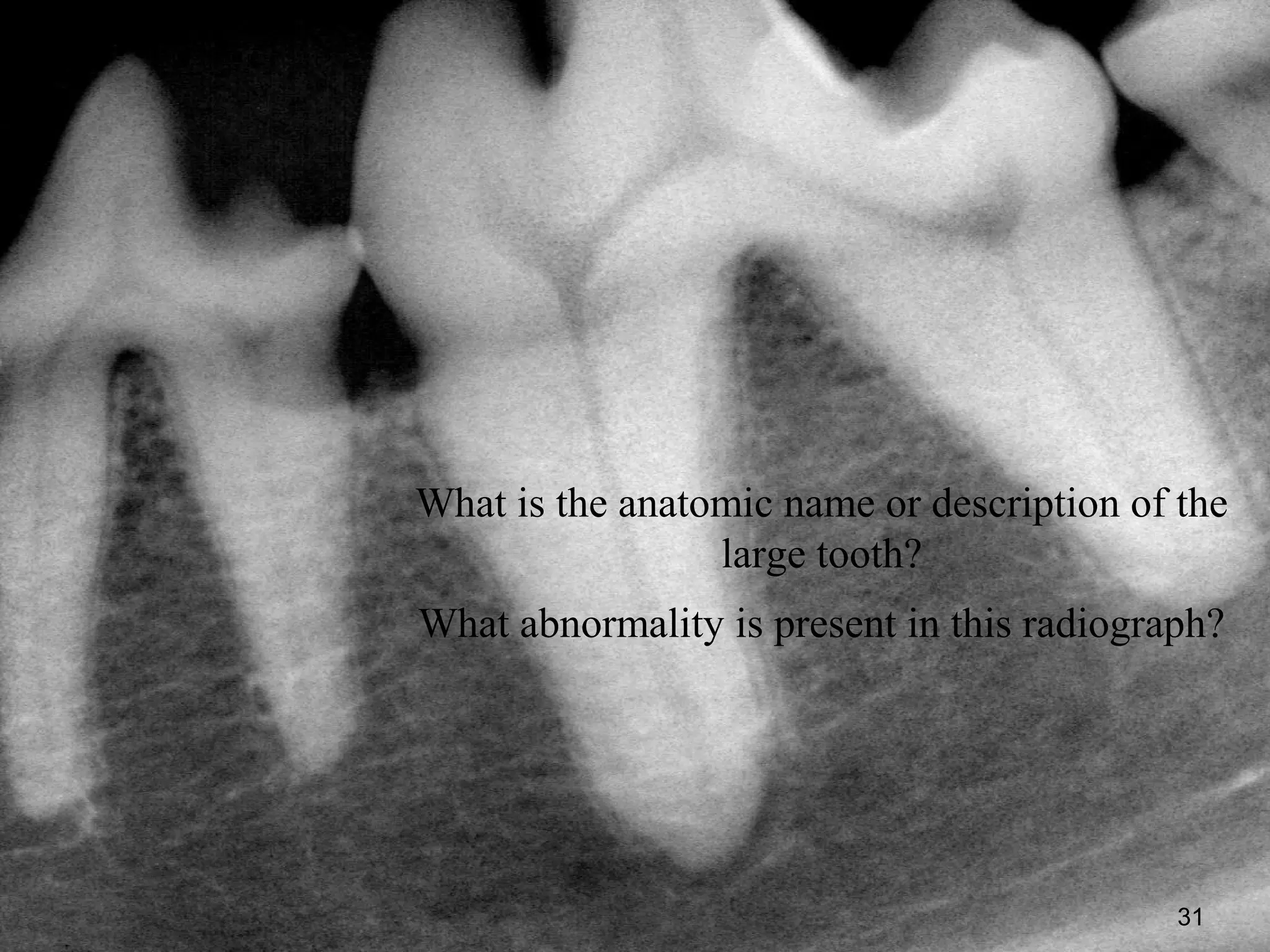 What is the anatomic name or description of the
                 large tooth?
What abnormality is present in this radiograph?




                                            31
 