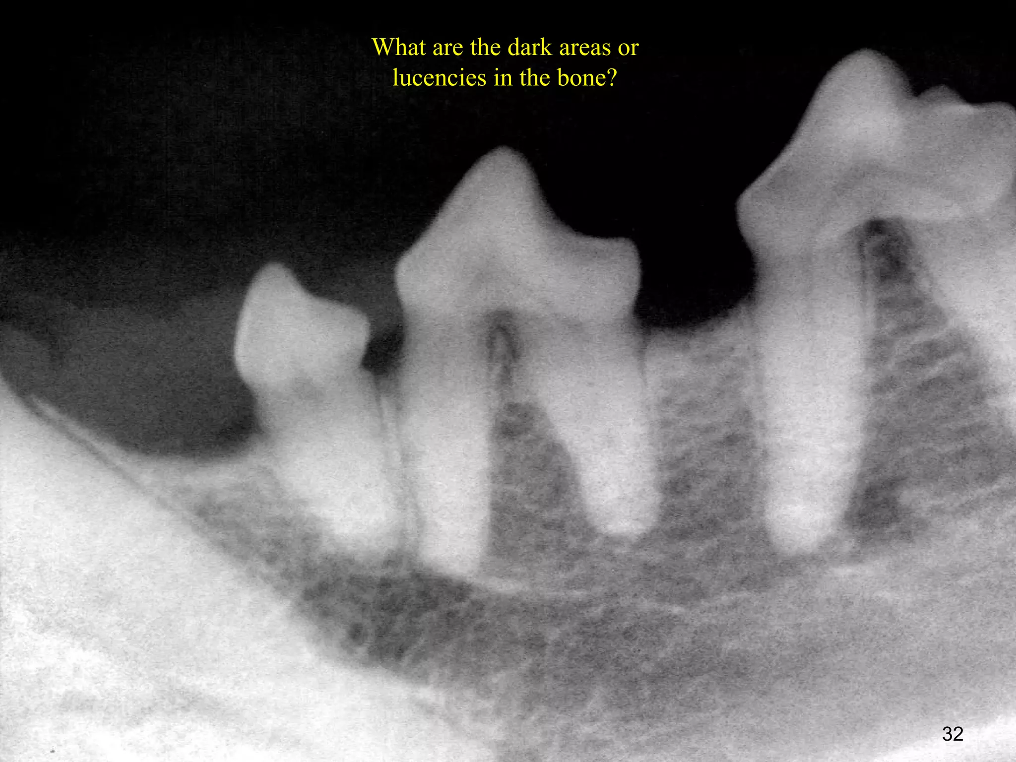 What are the dark areas or
 lucencies in the bone?




                             32
 