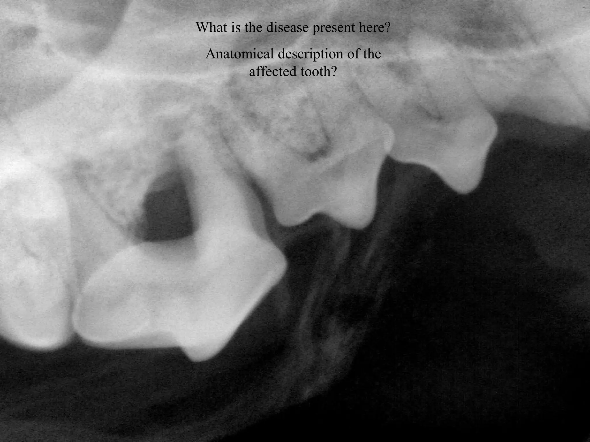 What is the disease present here?
 Anatomical description of the
       affected tooth?




                                    38
 