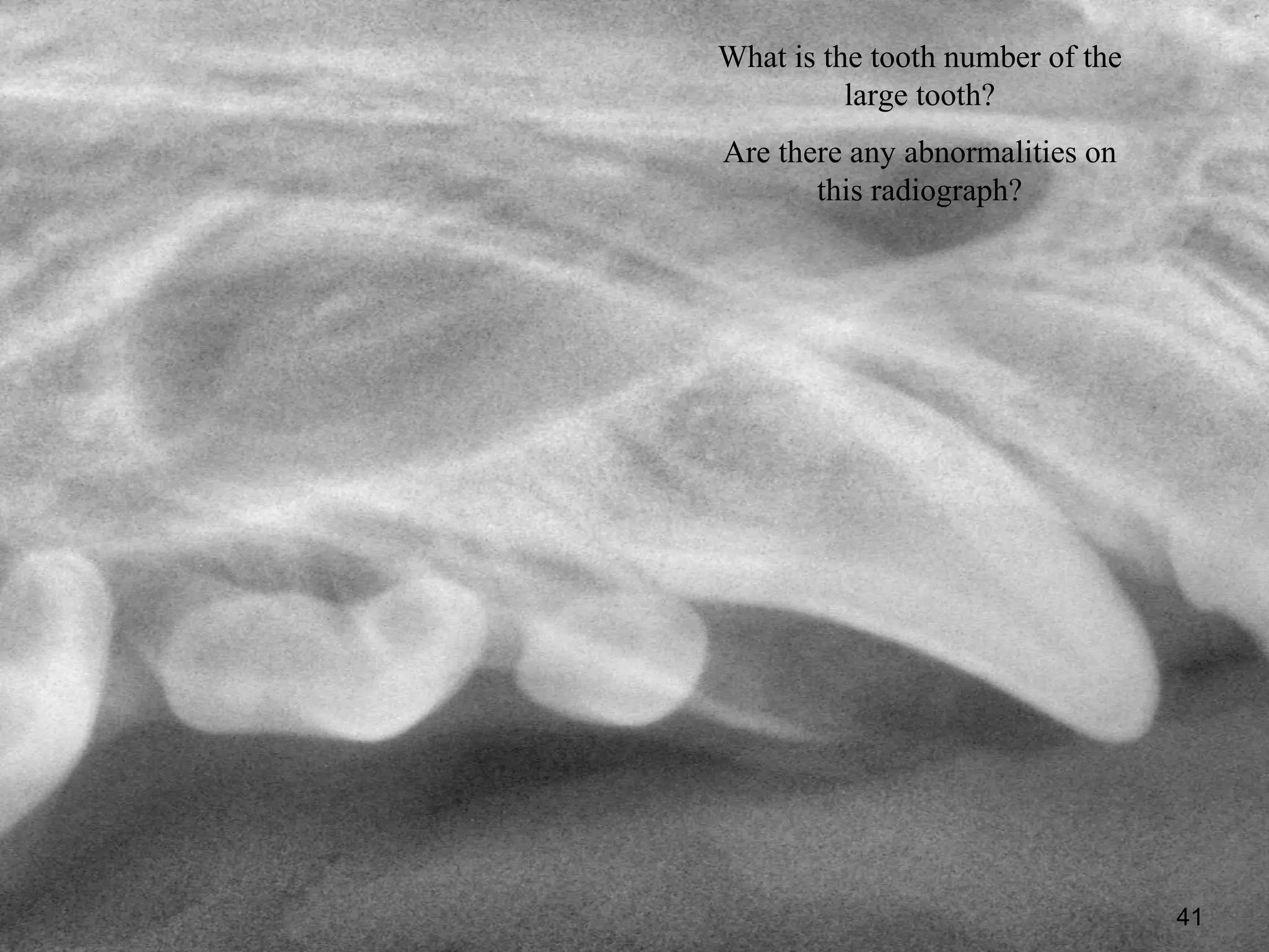 What is the tooth number of the
          large tooth?
Are there any abnormalities on
       this radiograph?




                                  41
 