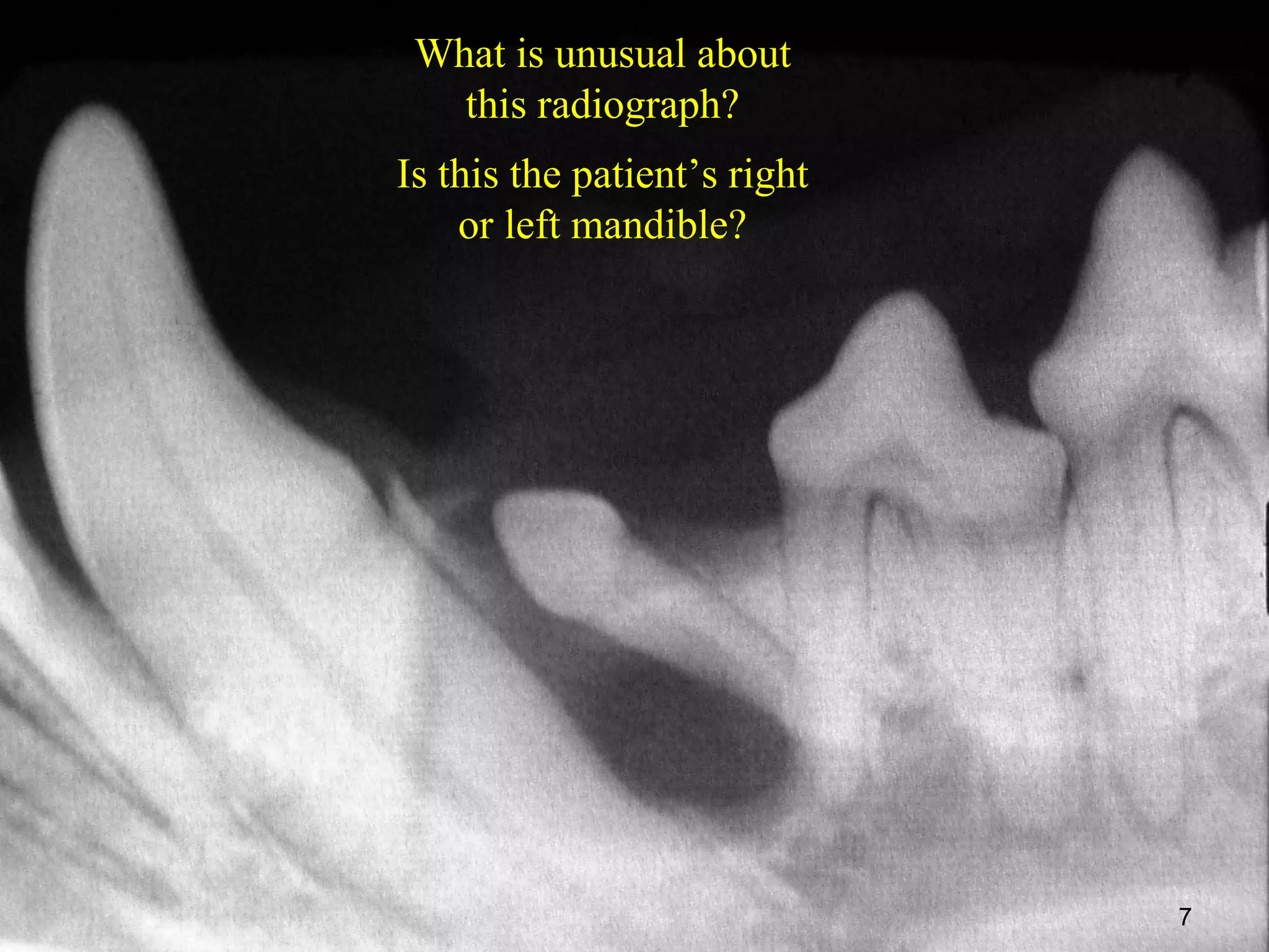 What is unusual about
   this radiograph?
Is this the patient’s right
    or left mandible?




                              7
 