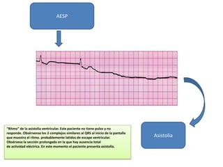 AESP




“Ritmo” de la asistolia ventricular. Este paciente no tiene pulso y no
responde. Obsérvense los 2 complejos similares al QRS al inicio de la pantalla
que muestra el ritmo. probablemente latidos de escape ventricular.               Asistolia
Obsérvese la sección prolongada en la que hay ausencia total
de actividad eléctrica. En este momento el paciente presenta asistolia.
 