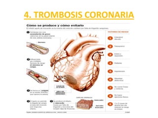 4. TROMBOSIS CORONARIA
 