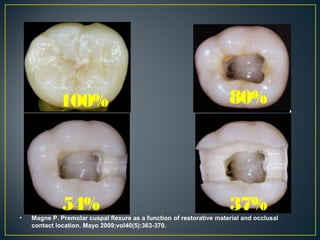 54% 37%
80%100%
• Magne P. Premolar cuspal flexure as a function of restorative material and occlusal
contact location. Mayo 2009;vol40(5):363-370.
 