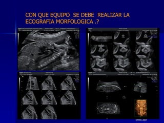 DTFRC-2007 CON QUE EQUIPO  SE DEBE  REALIZAR LA ECOGRAFIA MORFOLOGICA .? 