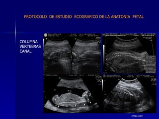 DTFRC-2007 COLUMNA VERTEBRAS CANAL PROTOCOLO  DE ESTUDIO  ECOGRAFICO DE LA ANATONIA  FETAL 