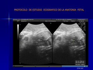 DTFRC-2007 PROTOCOLO  DE ESTUDIO  ECOGRAFICO DE LA ANATONIA  FETAL 