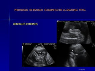 DTFRC-2007 GENITALES EXTERNOS PROTOCOLO  DE ESTUDIO  ECOGRAFICO DE LA ANATONIA  FETAL 