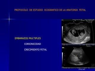 DTFRC-2007 EMBARAZOS MULTIPLES CORIONICIDAD CRECIMIENTO FETAL PROTOCOLO  DE ESTUDIO  ECOGRAFICO DE LA ANATONIA  FETAL 