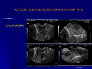 DTFRC-2007 CUELLO UTERINO PROTOCOLO  DE ESTUDIO  ECOGRAFICO DE LA ANATONIA  FETAL 