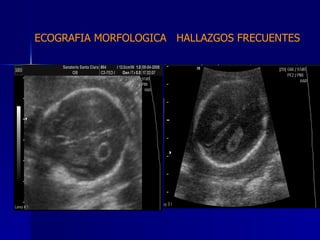 ECOGRAFIA MORFOLOGICA  HALLAZGOS FRECUENTES   