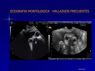 DTFRC-2007 ECOGRAFIA MORFOLOGICA  HALLAZGOS FRECUENTES   