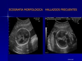 DTFRC-2007 ECOGRAFIA MORFOLOGICA  HALLAZGOS FRECUENTES   