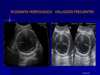 DTFRC-2007 ECOGRAFIA MORFOLOGICA  HALLAZGOS FRECUENTES   