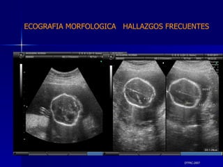 DTFRC-2007 ECOGRAFIA MORFOLOGICA  HALLAZGOS FRECUENTES   