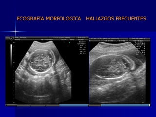 ECOGRAFIA MORFOLOGICA  HALLAZGOS FRECUENTES   