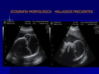 ECOGRAFIA MORFOLOGICA  HALLAZGOS FRECUENTES   