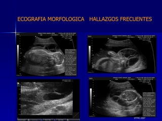 DTFRC-2007 ECOGRAFIA MORFOLOGICA  HALLAZGOS FRECUENTES   